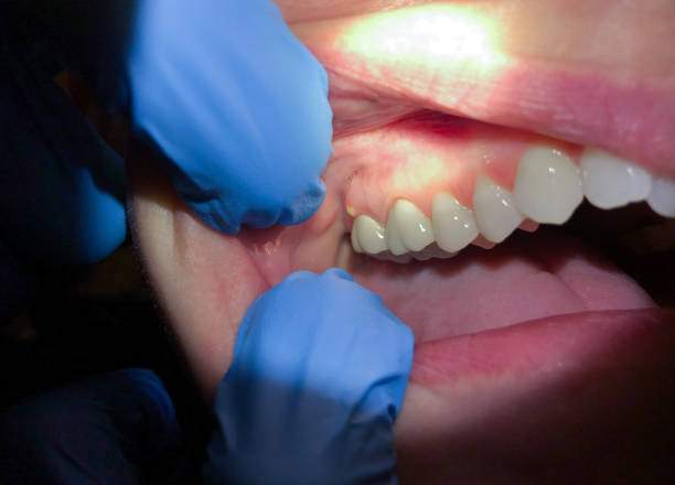 Best Emergency Root Canal Treatment in Simpsonville, KY
